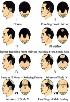 Hair Loss Explained - Non Surgical Hair Replacement Specialists : Hair Loss  Solutions : Regrowth Service : Trichotillomania Cures : Female Hair Loss  Treatment : Thinning Product : Balding : Hair Integration